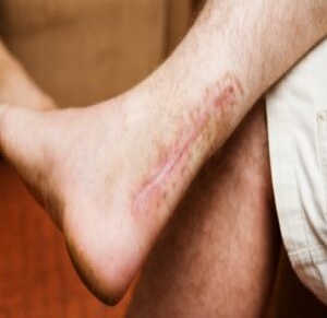 Achilles Tendon Surgery For Athletes